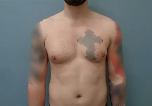 Gynecomastia Before & After Pictures in Nashville, TN