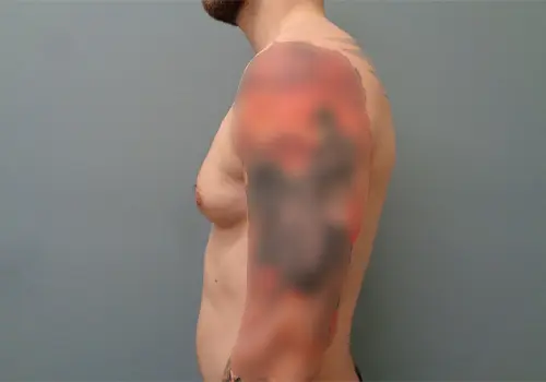Gynecomastia Before & After Pictures in Nashville, TN