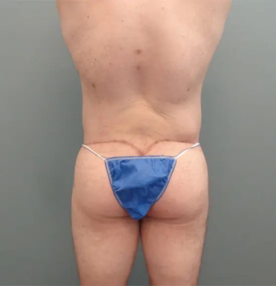 Body Lift Before & After Pictures in Nashville, TN