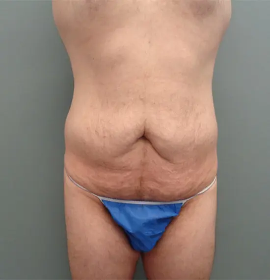 Body Lift Before & After Pictures in Nashville, TN