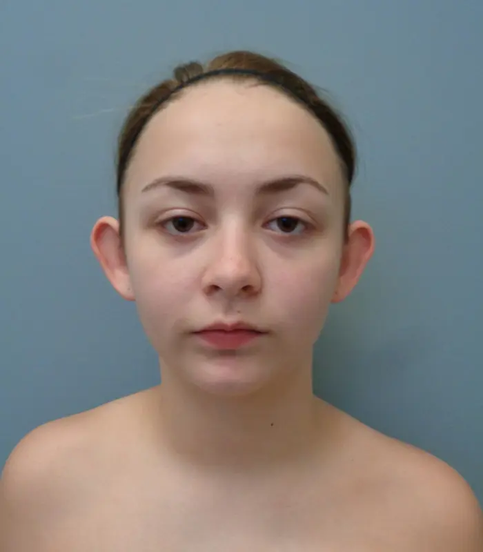 Otoplasty Before and After Pictures Nashville, TN