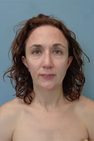 Rhinoplasty Before & After Pictures in Nashville, TN