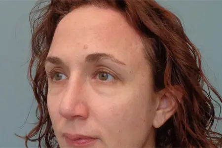 Brow Lift Before and After Pictures in Nashville, TN