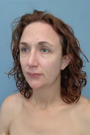 Rhinoplasty Before & After Pictures in Nashville, TN