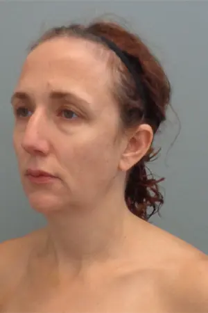 Rhinoplasty Before & After Pictures in Nashville, TN