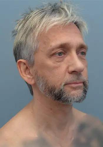 Rhinoplasty Before & After Pictures in Nashville, TN