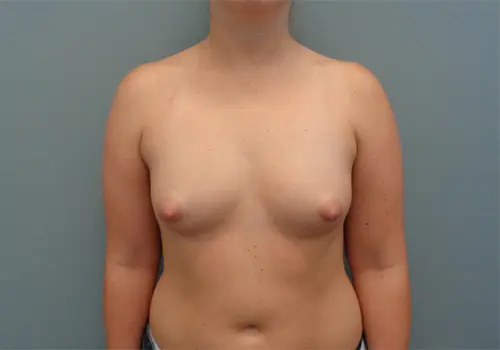 Breast Augmentation Before & After Pictures in Nashville, TN