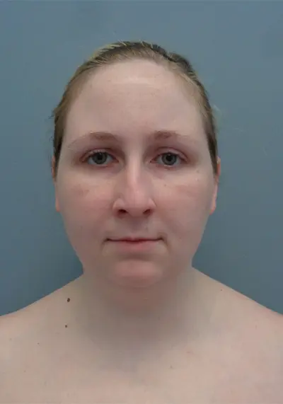 Rhinoplasty Before & After Pictures in Nashville, TN