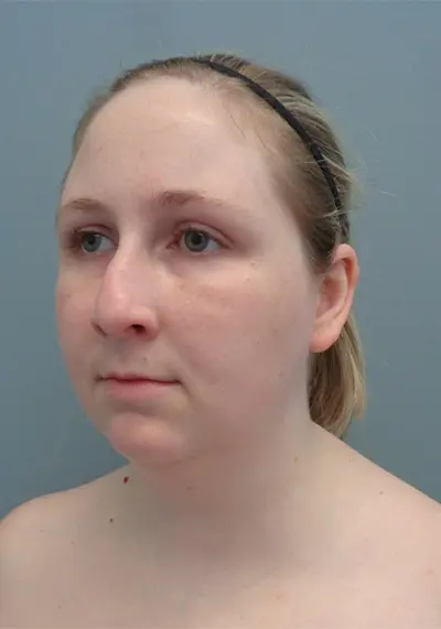 Rhinoplasty Before & After Pictures in Nashville, TN