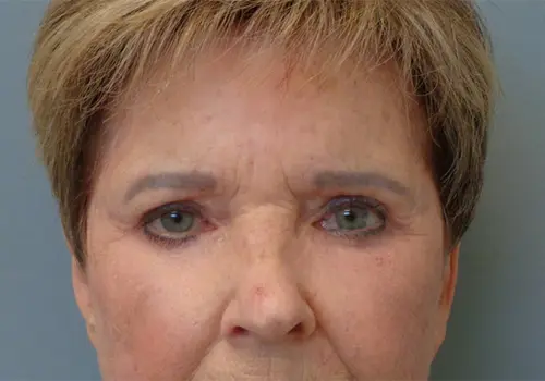 Blepharoplasty Before & After Pictures In Nashville, TN
