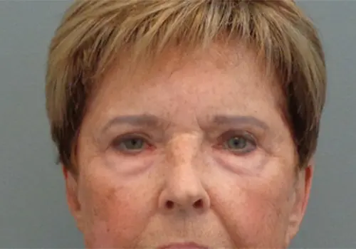 Blepharoplasty Before & After Pictures In Nashville, TN