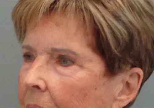 Blepharoplasty Before & After Pictures In Nashville, TN