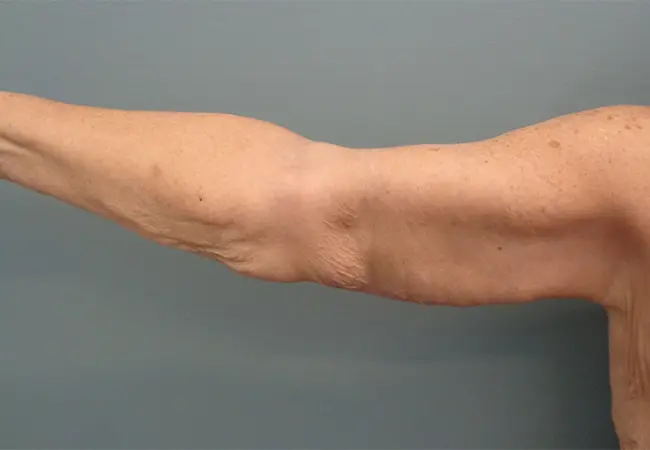 Arm Lift Before & After Pictures in Nashville, TN