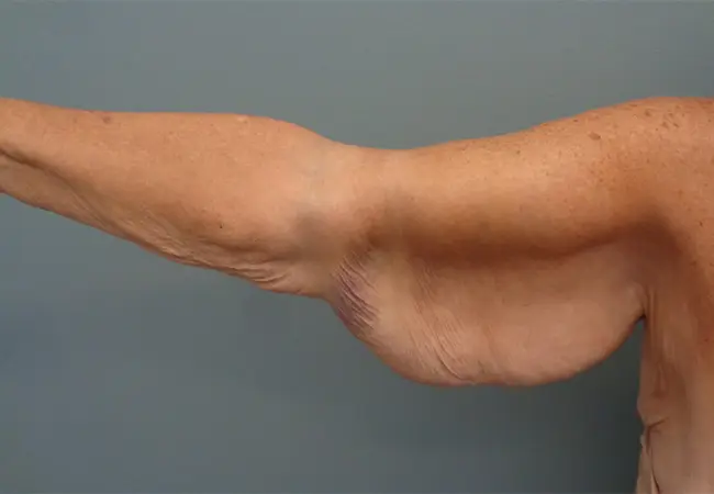 Arm Lift Before & After Pictures in Nashville, TN
