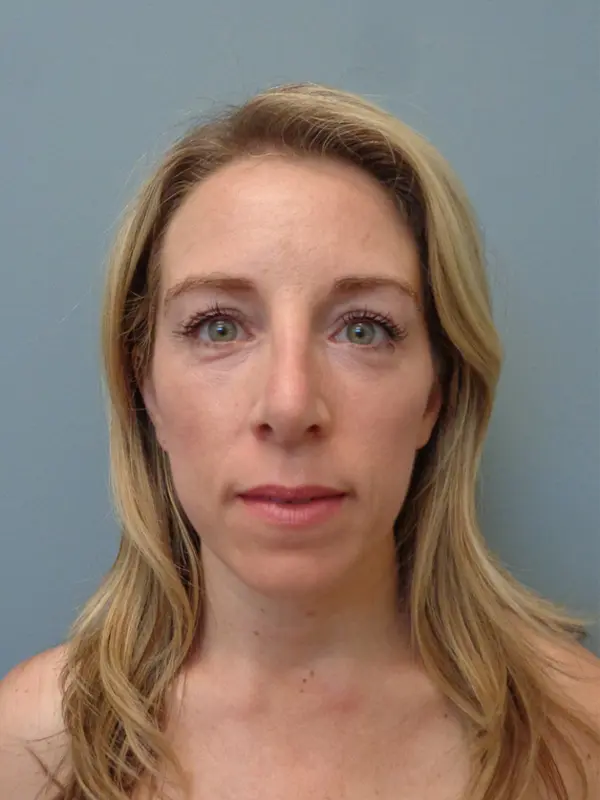 Rhinoplasty Before & After Pictures in Nashville, TN