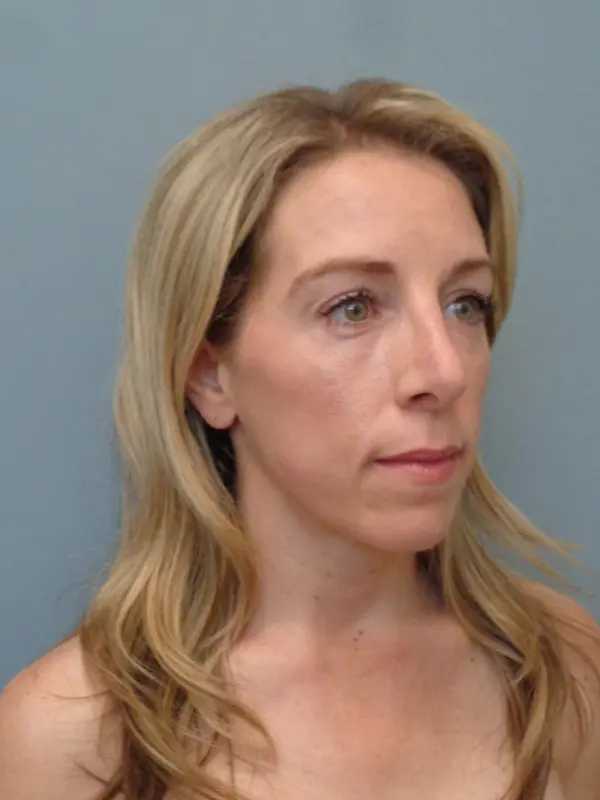 Rhinoplasty Before & After Pictures in Nashville, TN