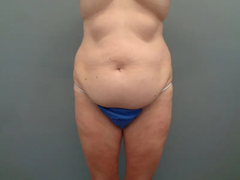 Tummy Tuck Before & After Pictures in Nashville, TN