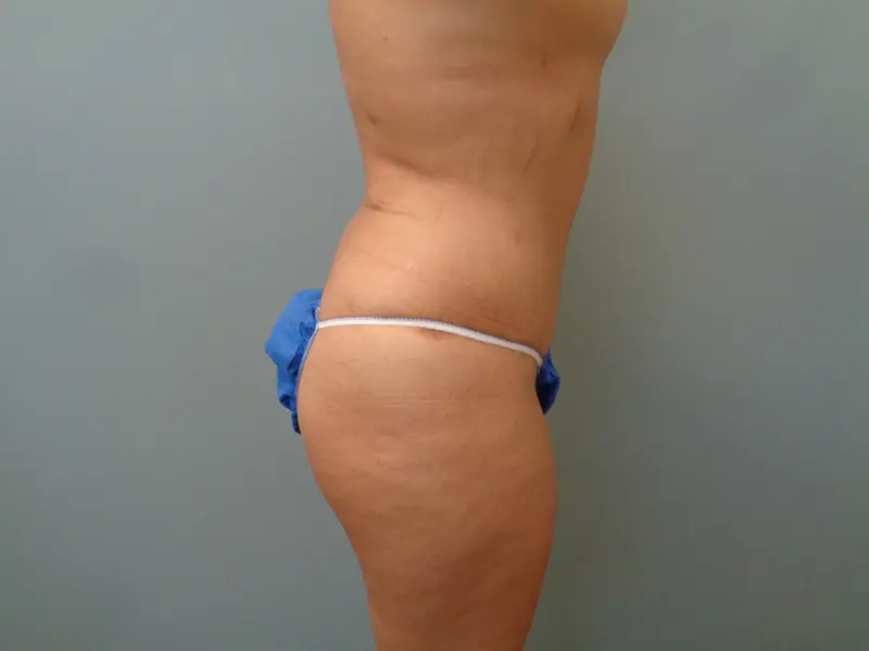 Tummy Tuck Before & After Pictures in Nashville, TN