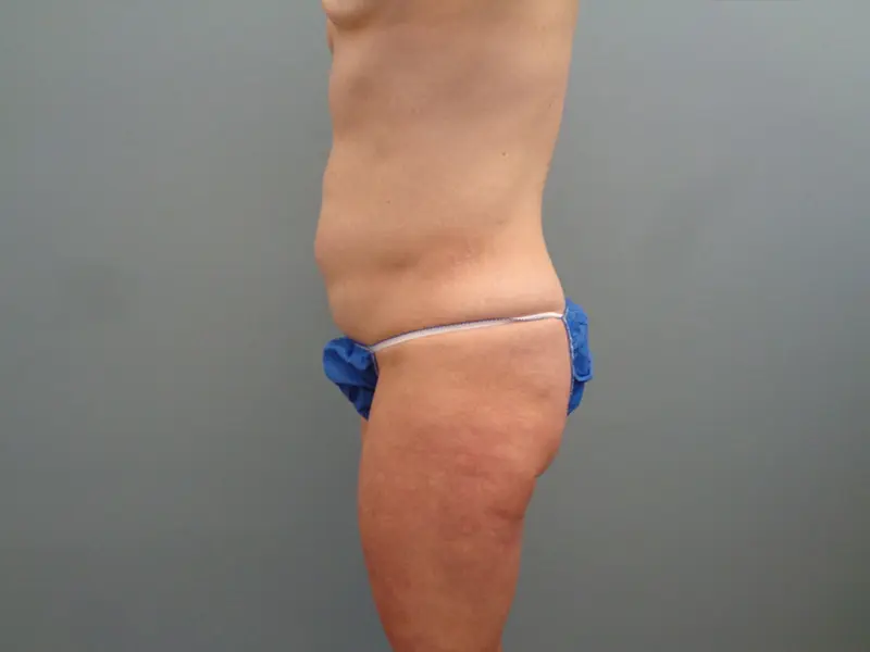 Tummy Tuck Before & After Pictures in Nashville, TN