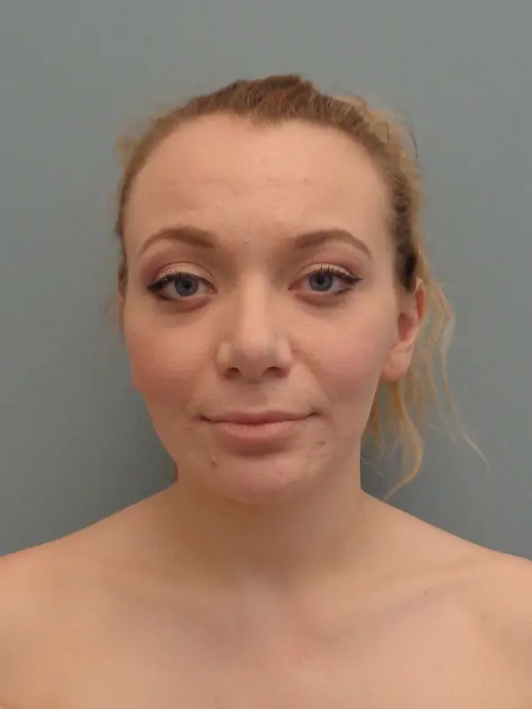 Rhinoplasty Before & After Pictures in Nashville, TN