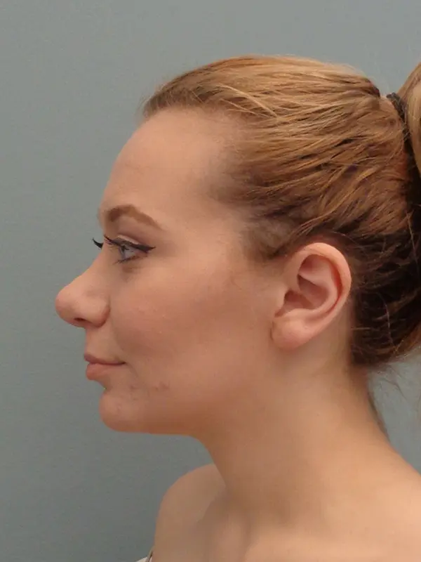 Rhinoplasty Before & After Pictures in Nashville, TN