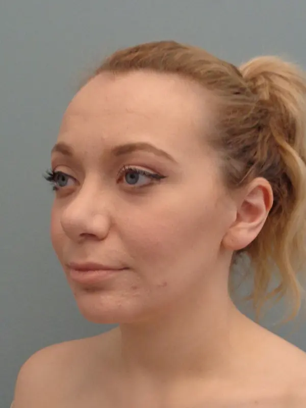 Rhinoplasty Before & After Pictures in Nashville, TN