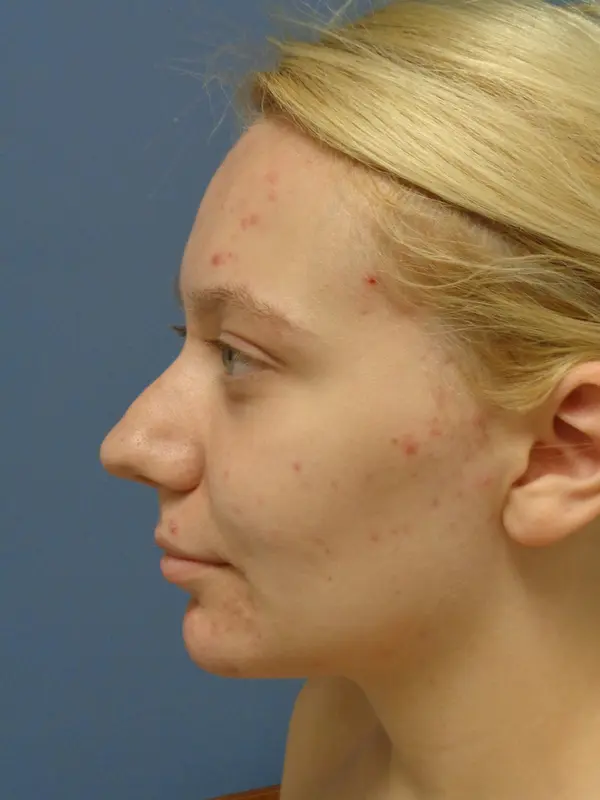 Rhinoplasty Before & After Pictures in Nashville, TN
