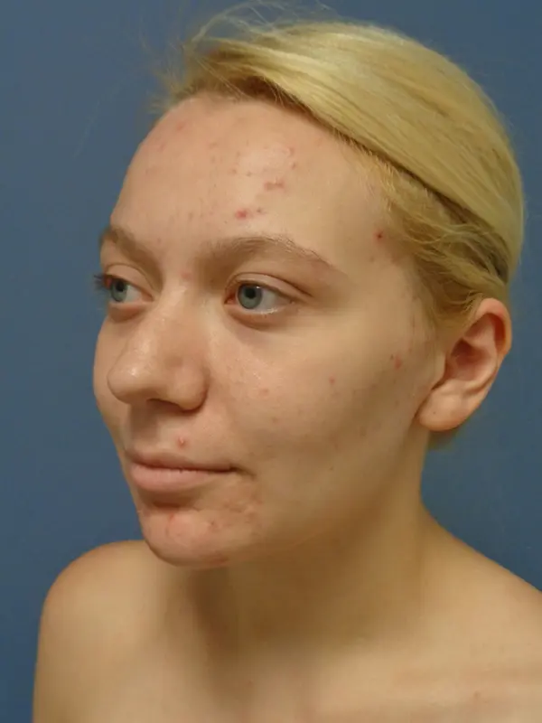 Rhinoplasty Before & After Pictures in Nashville, TN