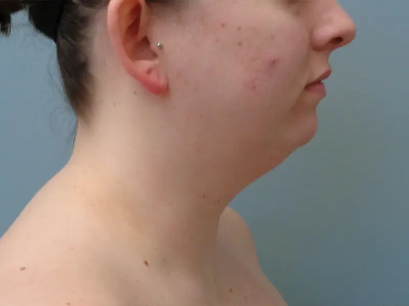 Chin Augmentation Before & After Pictures in Nashville, TN