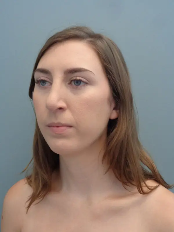 Rhinoplasty Before & After Pictures in Nashville, TN