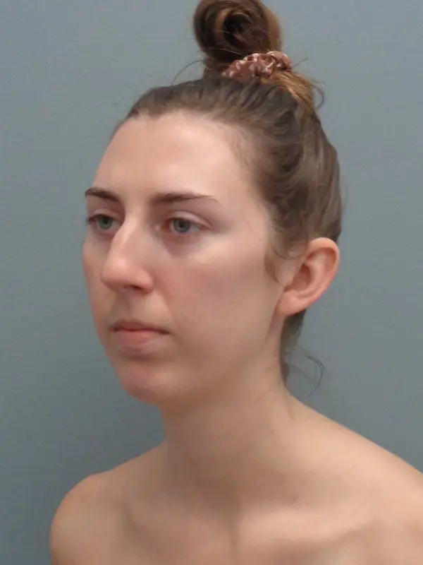Rhinoplasty Before & After Pictures in Nashville, TN