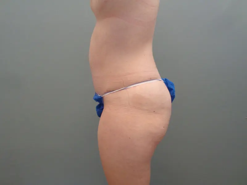Tummy Tuck Before & After Pictures in Nashville, TN