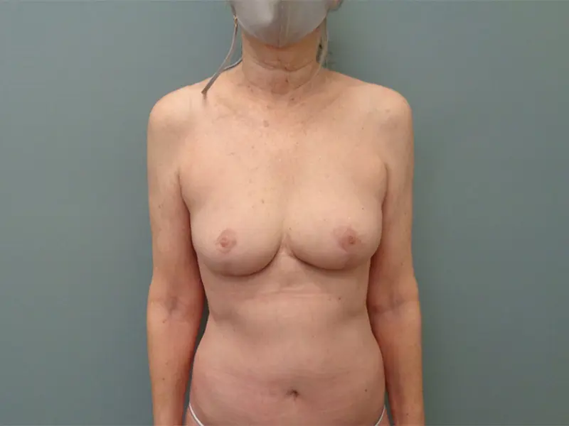 Mommy Makeover Before & After Pictures in Nashville, TN