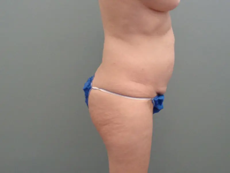 Mommy Makeover Before & After Pictures in Nashville, TN