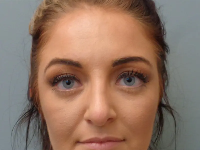 Blepharoplasty Before & After Pictures In Nashville, TN