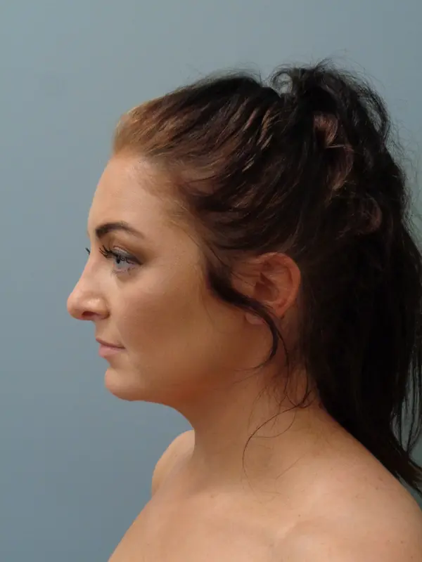 Rhinoplasty Before & After Pictures in Nashville, TN