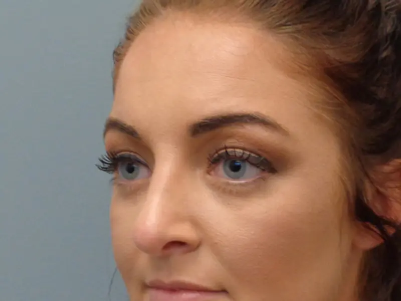 Blepharoplasty Before & After Pictures In Nashville, TN