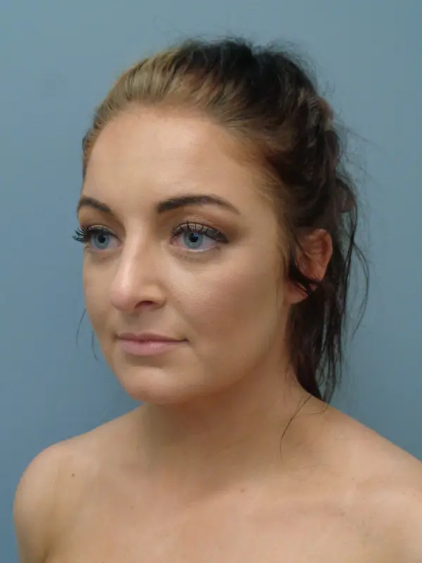 Rhinoplasty Before & After Pictures in Nashville, TN