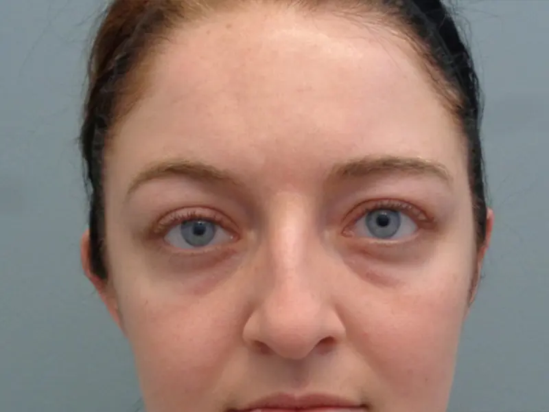 Blepharoplasty Before & After Pictures In Nashville, TN