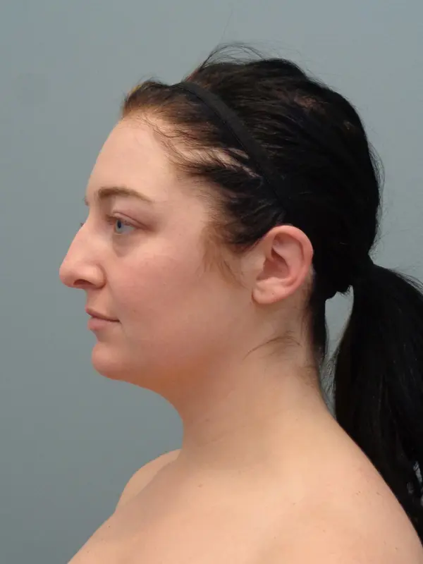 Rhinoplasty Before & After Pictures in Nashville, TN