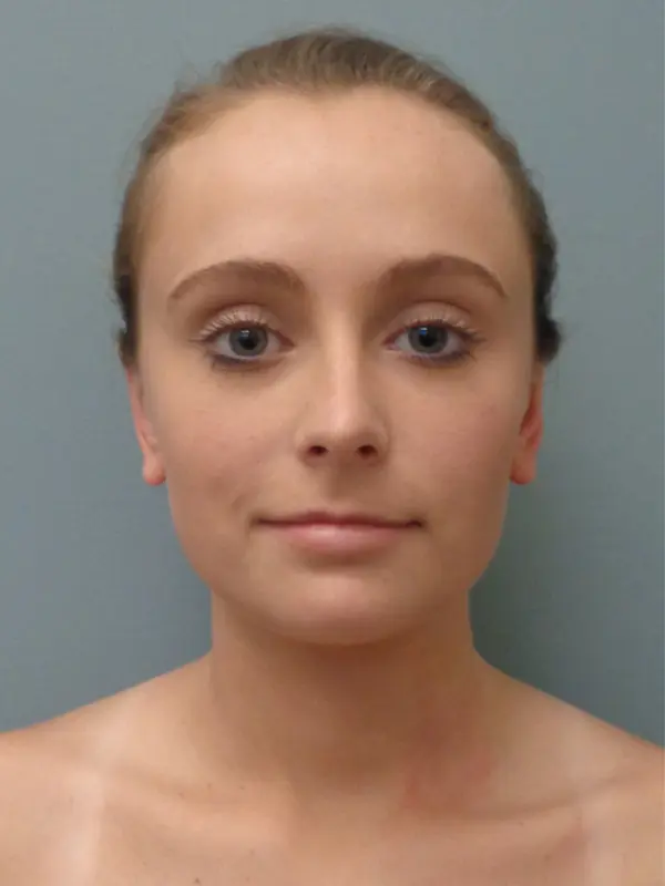 Otoplasty Before & After Pictures in Nashville, TN