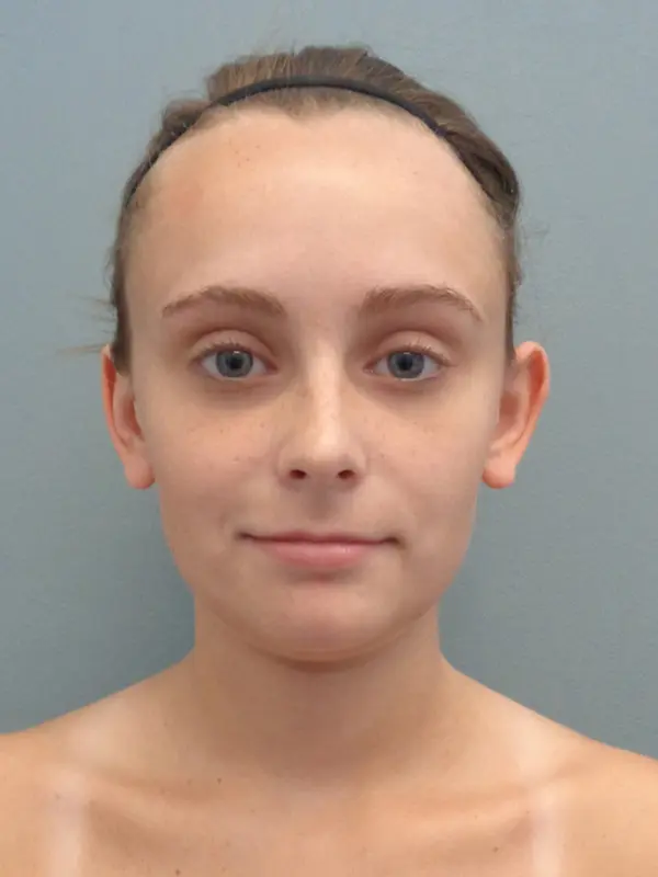 Otoplasty Before & After Pictures in Nashville, TN