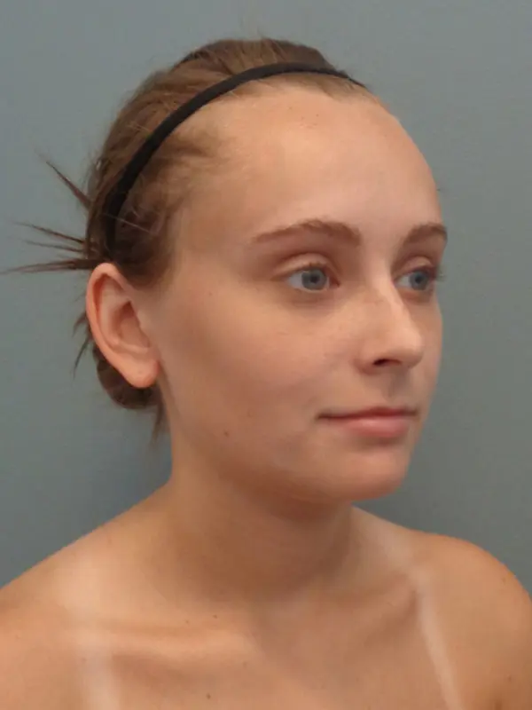 Otoplasty Before & After Pictures in Nashville, TN