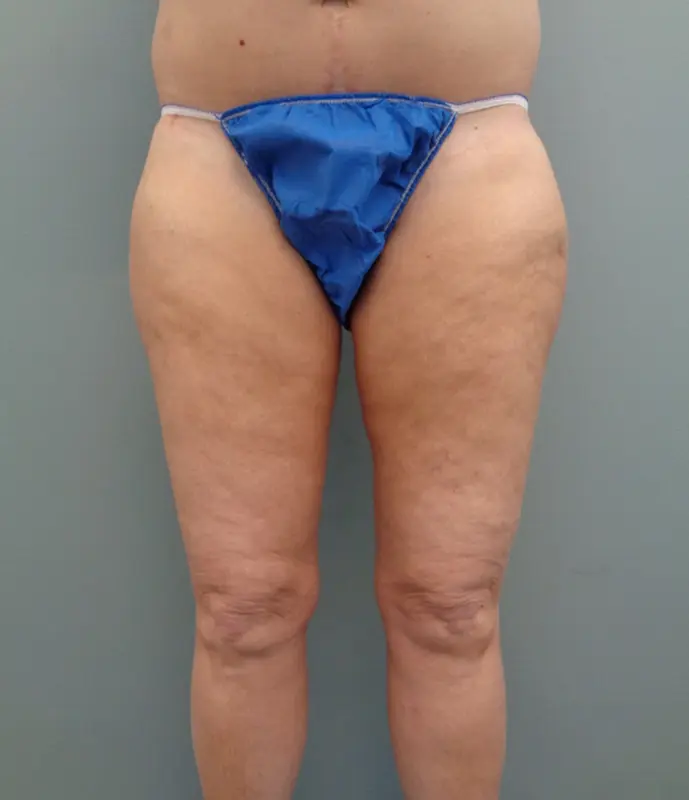 Thigh Lift Before & After Pictures in Nashville, TN