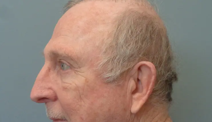 Blepharoplasty Before & After Pictures in Nashville, TN