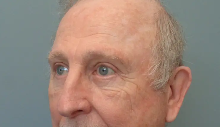 Blepharoplasty Before & After Pictures in Nashville, TN