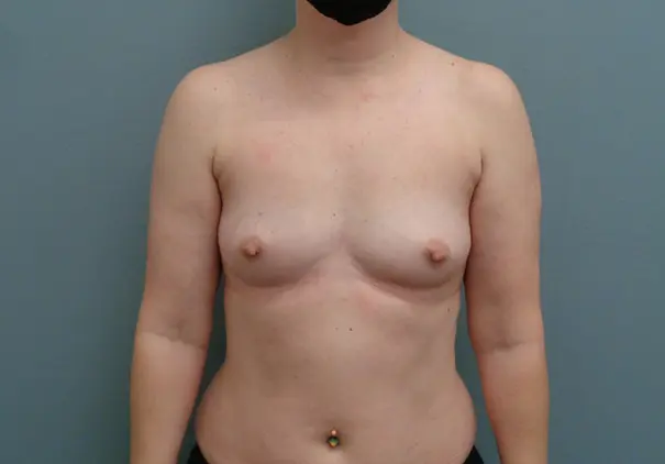 Breast Augmentation Before & After Pictures in Nashville, TN