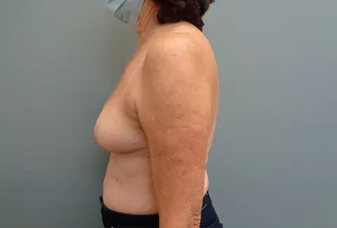 Breast Reduction Before & After Pictures in Nashville, TN