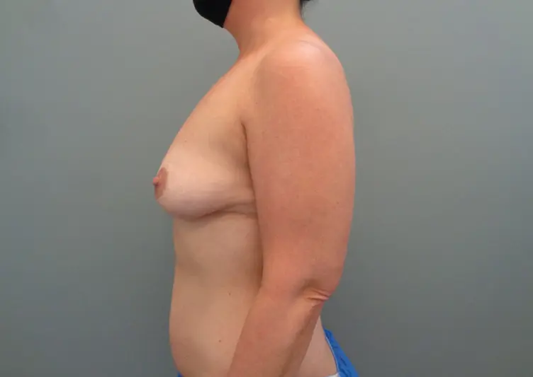 Breast augmentation with Lift Before & After Pictures in Nashville, TN