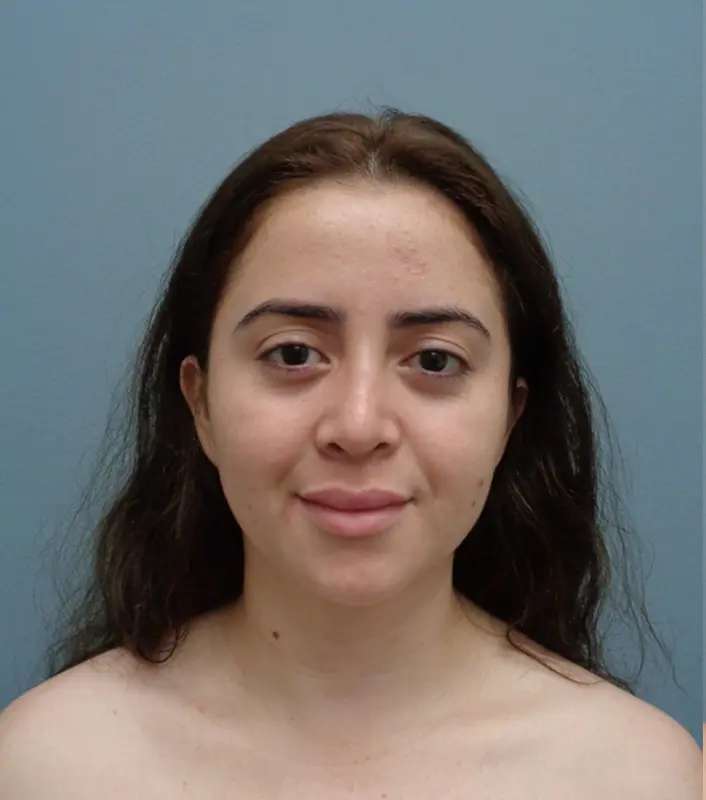 Rhinoplasty Before & After Pictures in Nashville, TN